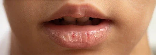 CHAPPED LIPS - AYURVEDIC REMEDIES AND TIPS