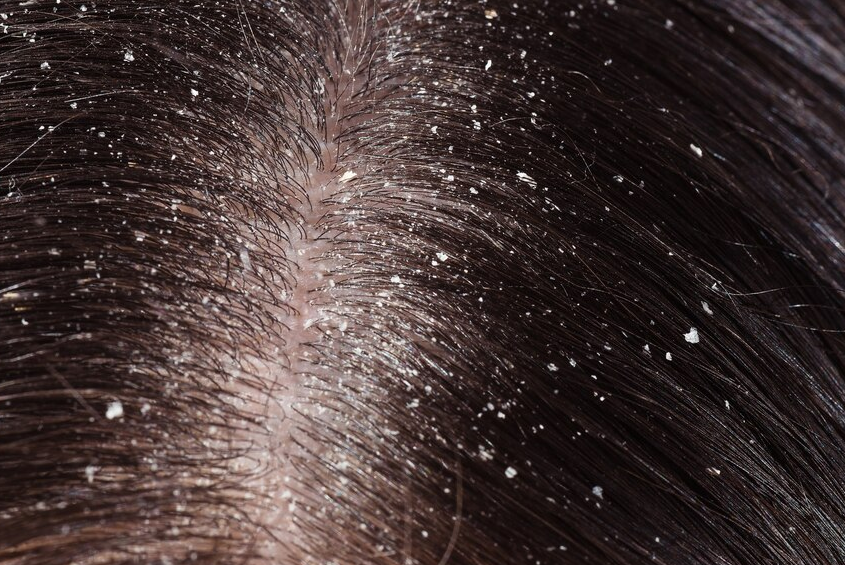 Get Rid of Dandruff & Itchy Scalp with Ayurveda