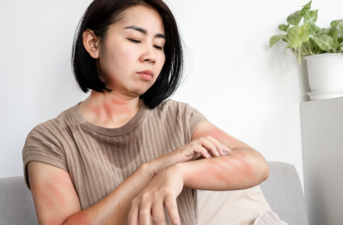 ayurveda for eczema